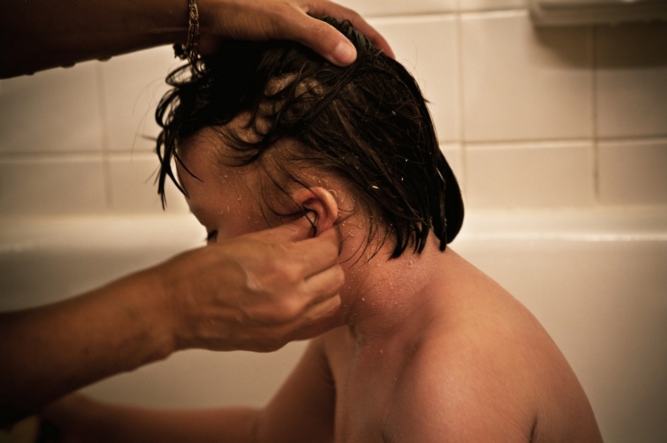 孤兒?。呼~鱗病女孩的艱難生活【圖】