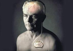 起搏器真的能治好帕金森病嗎？