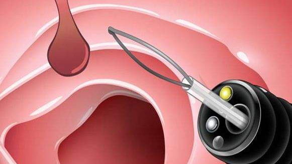 【健康解碼&middot;小貼士】檢查出息肉 需要切除嗎？